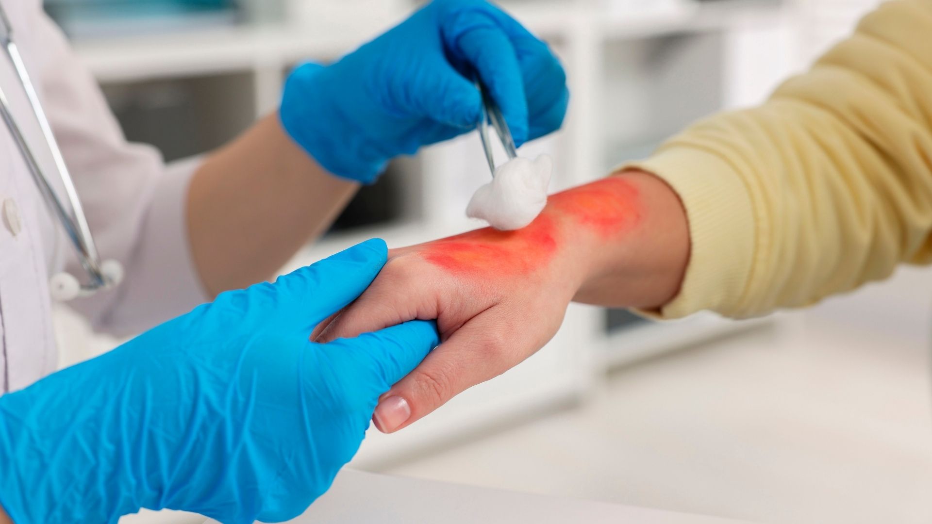 burn injuries understanding your legal rights and compensation options