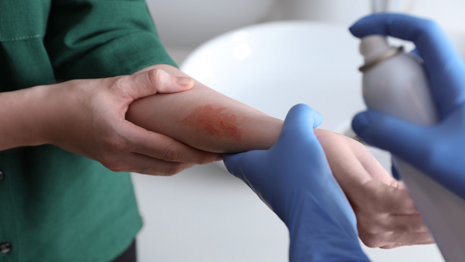 burn injury treatment and recovery what victims need to know