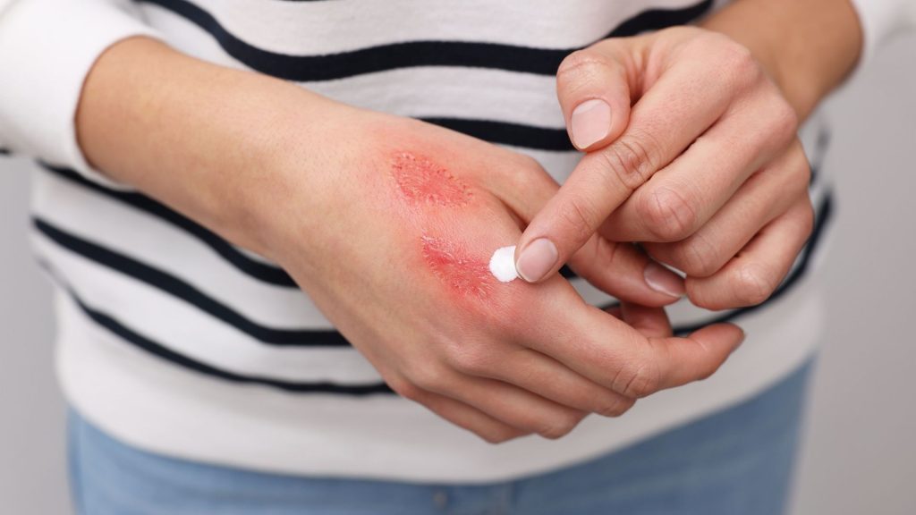 common causes of burn injuries and who can be held liable