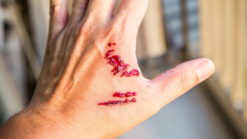 what to do immediately after a dog bite injury